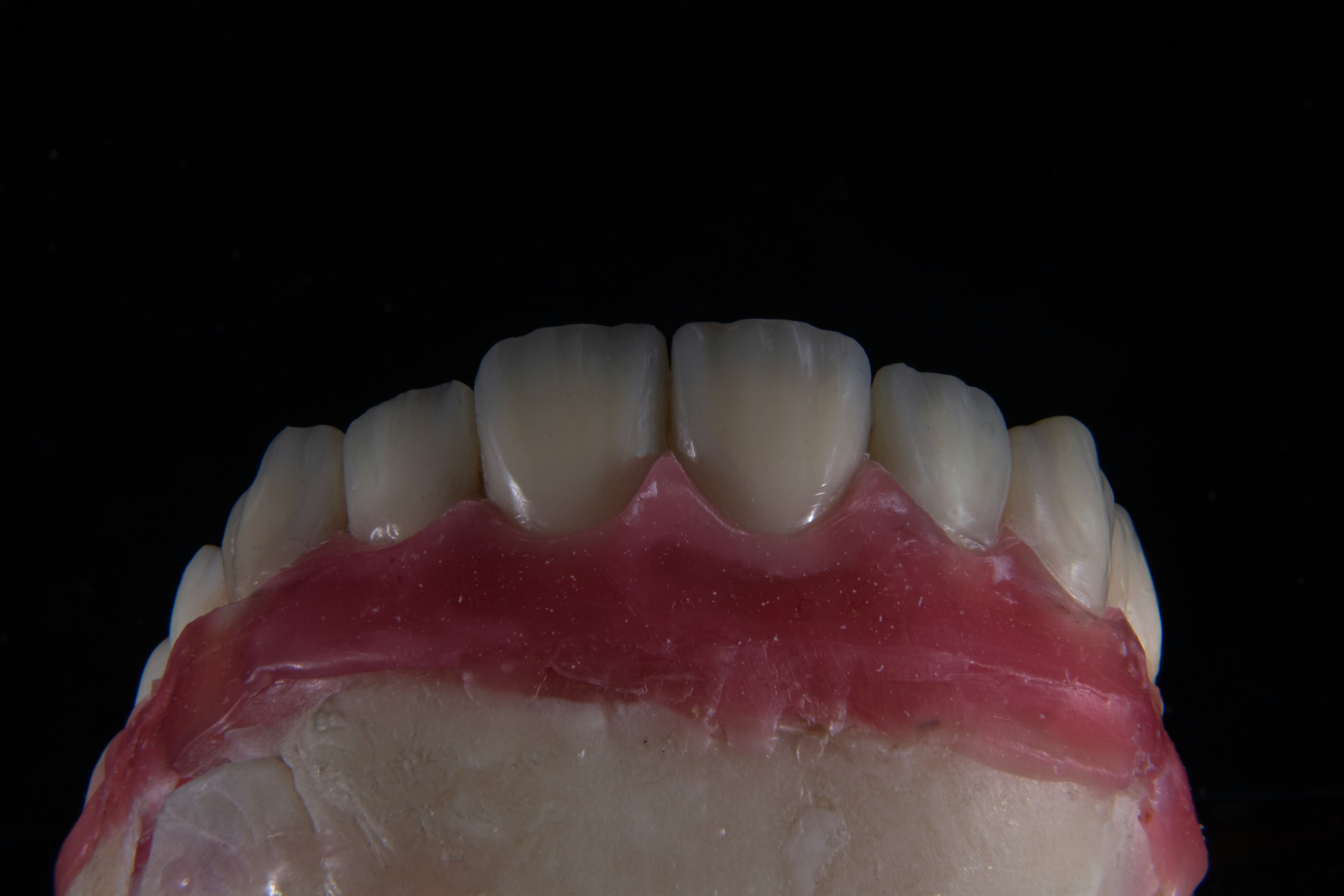 Example of implant-supported dentures in the mouth