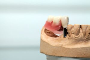 Ceramic Implants in Gillette WY