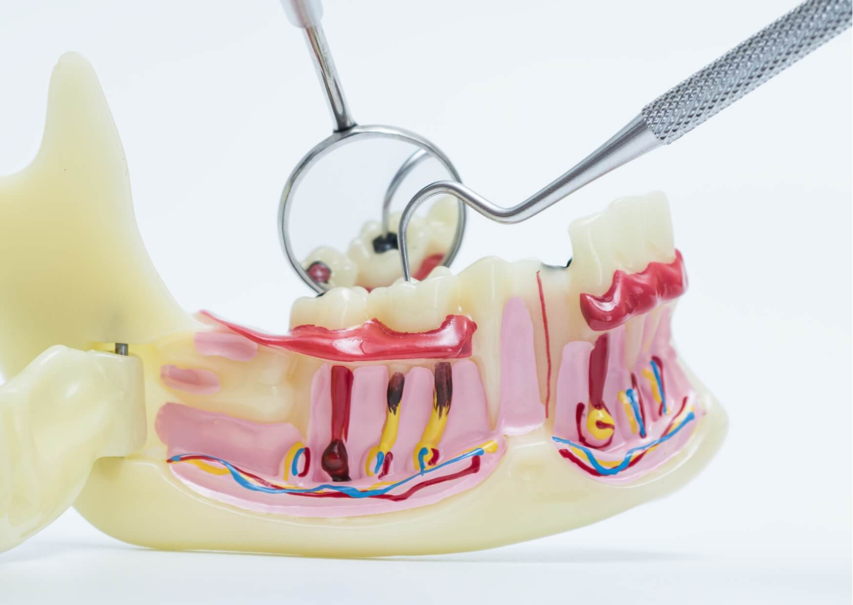 Cross-sectional tooth model showing early tooth decay and cavities that require dental treatment rather than healing on their own.