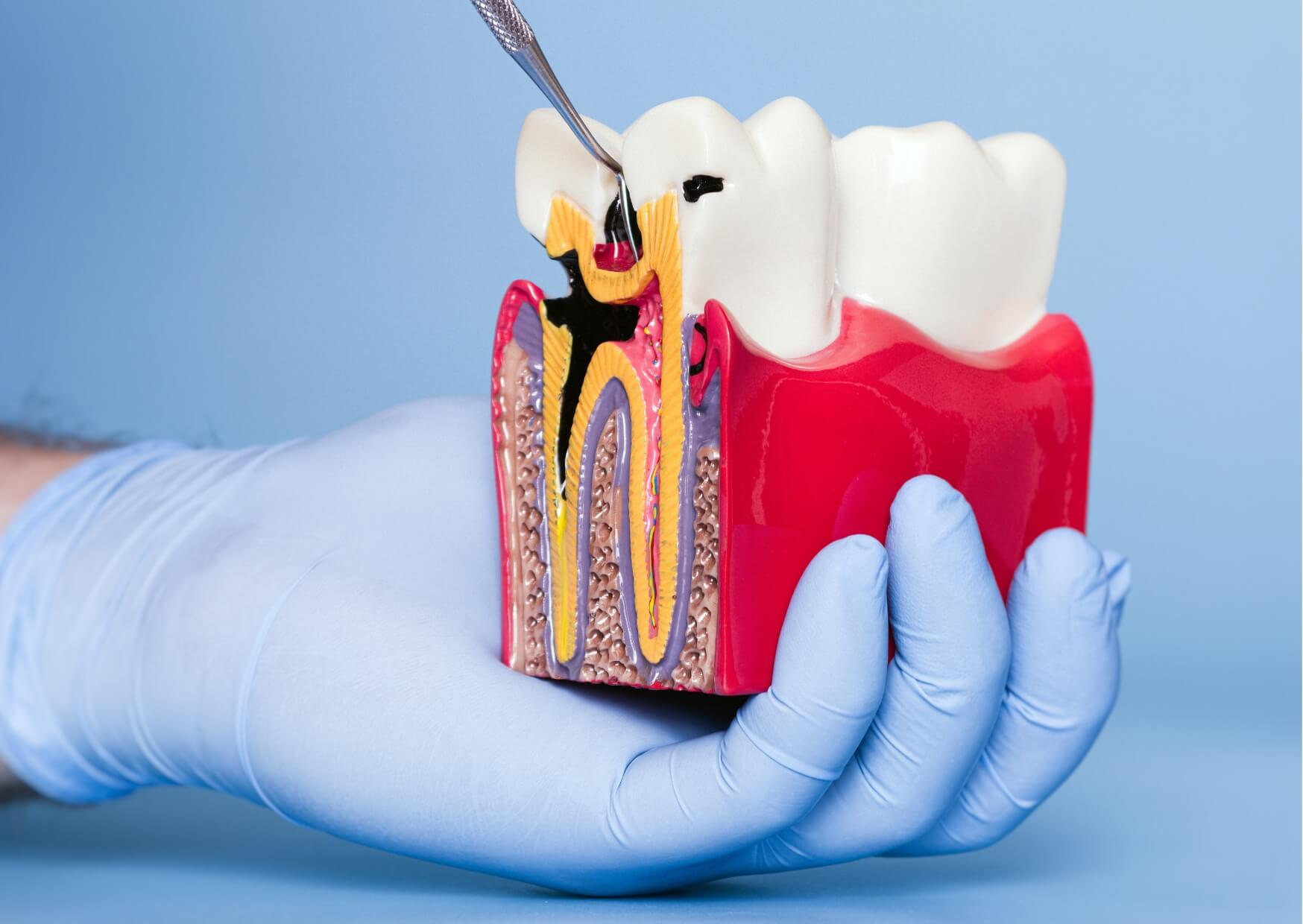 Cross-sectional tooth model showing deep decay and infection reaching the inner pulp and root canals.