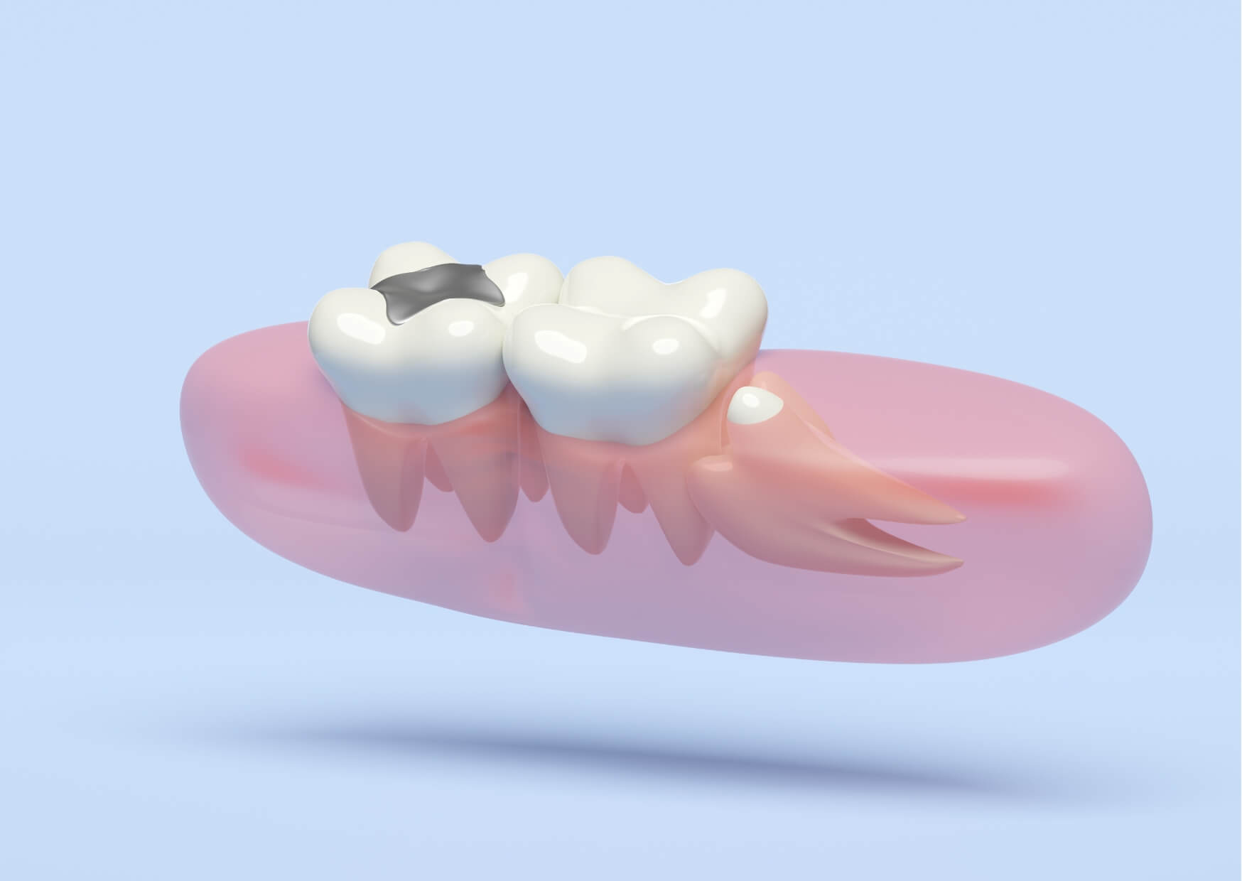 Illustration of an impacted wisdom tooth trapped beneath the gums beside a healthy molar, showing why impacted wisdom teeth may require removal.